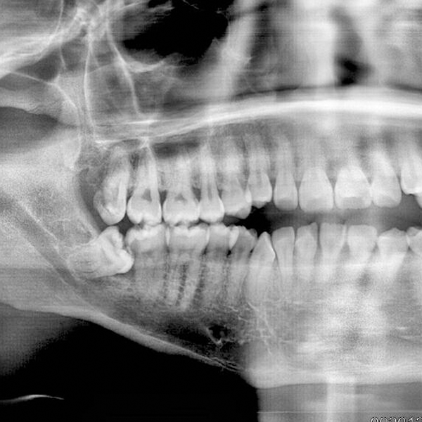 wisdom teeth impaction