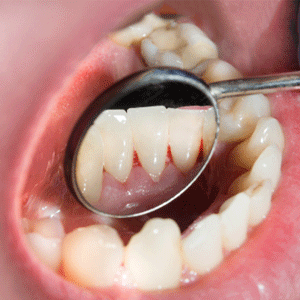 gum disease